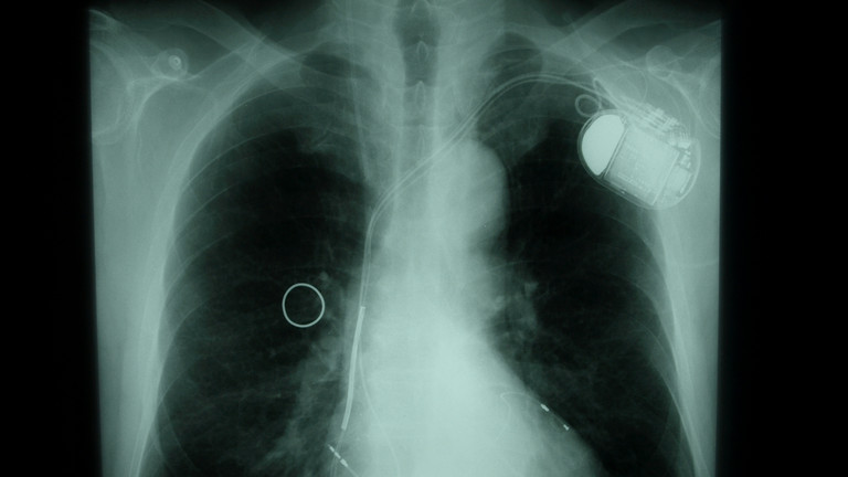 Herzschrittmacher, Herzinsuffizienz, Devicetherapie